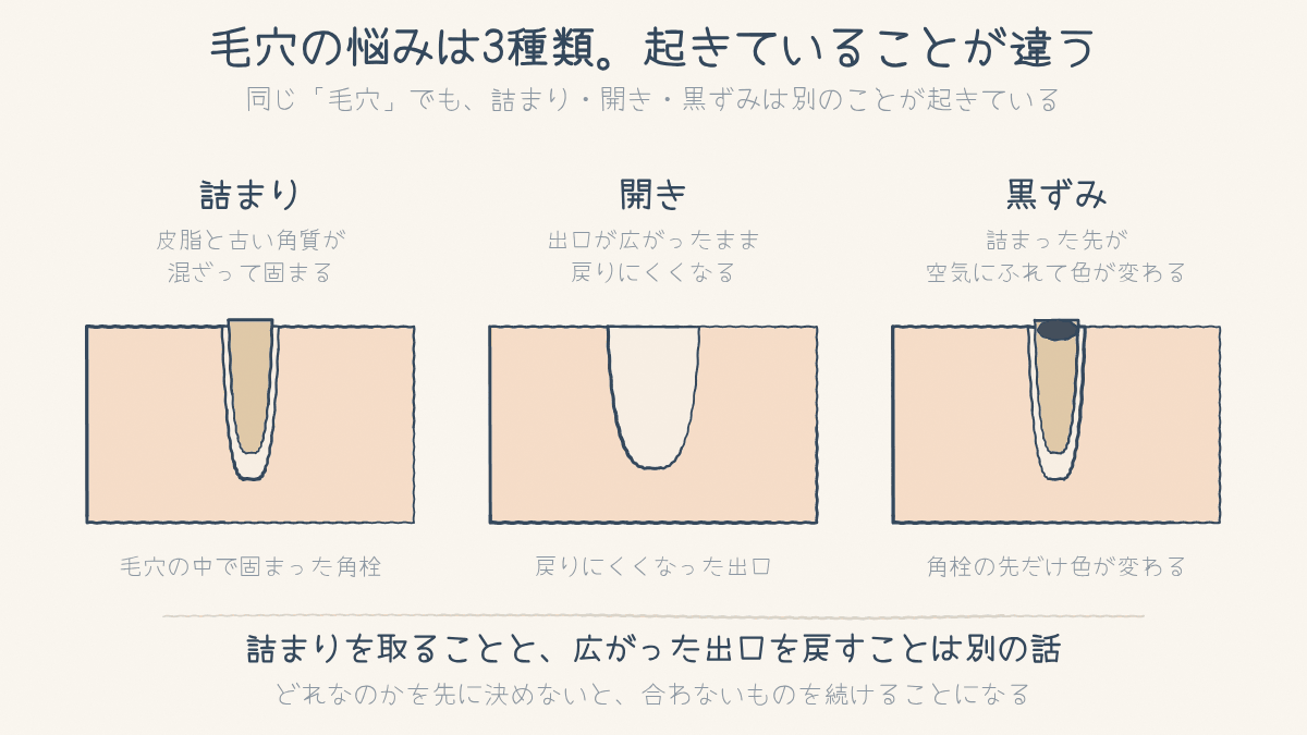 毛穴の断面3つ。詰まり・開き・黒ずみで起きていることが違うことを並べた図