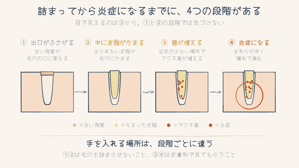 毛穴の出口がふさがり、皮脂がたまり、菌が増え、炎症になるまでの4段階の図